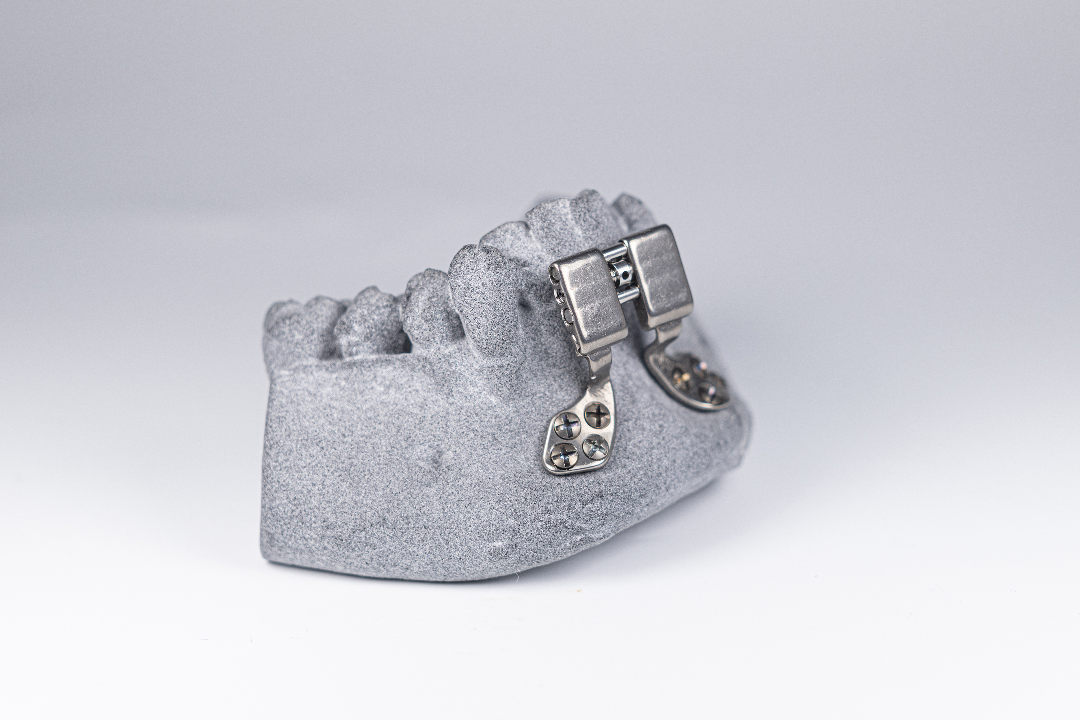 Today, orthodontic distractors are manufactured as a standard part and only adjusted during the surgical process: tedious and uncomfortable for the patient. Additive manufacturing is designed to shorten lead times and enable an individualized fit for the patient.